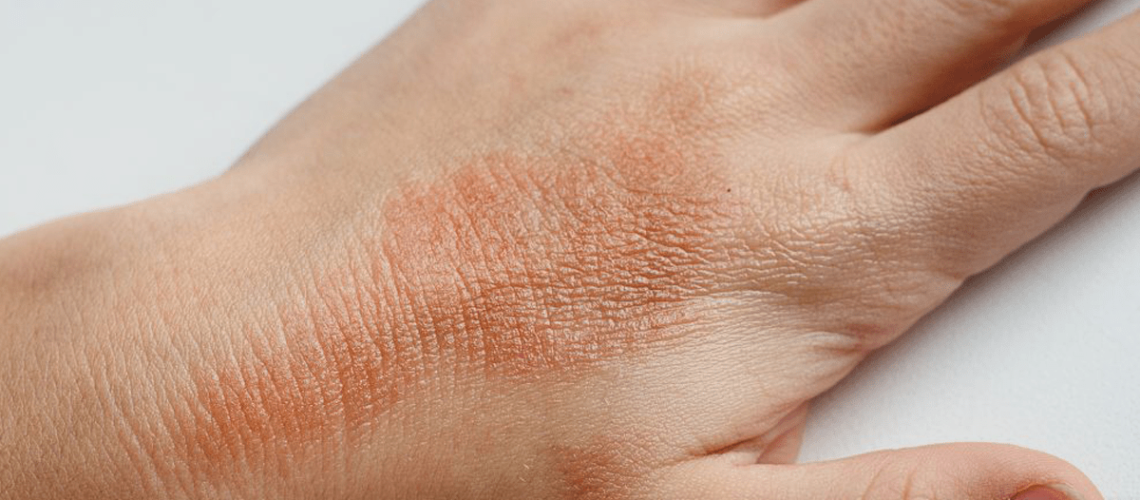 dermatita-atopica