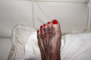 neuroma de morton