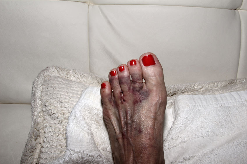 neuroma de morton