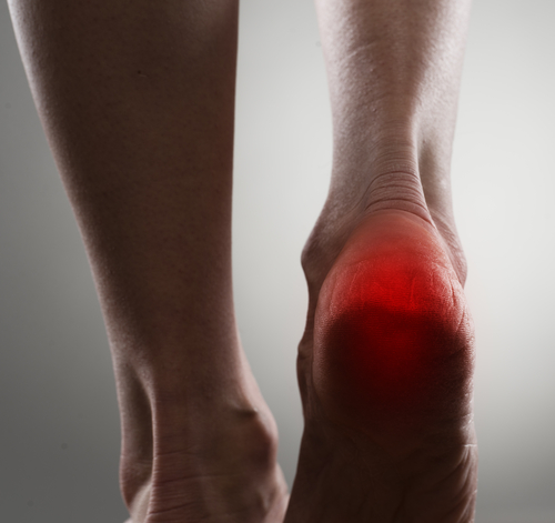 Esporão e fascite plantar