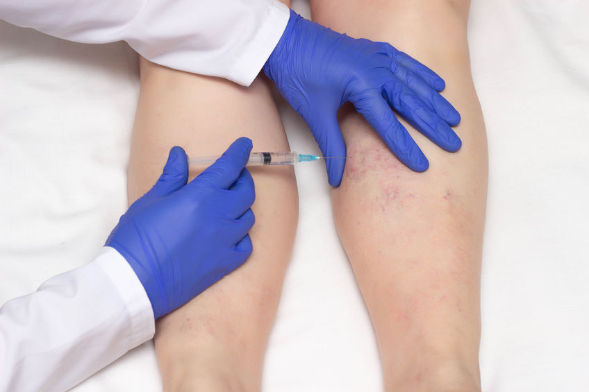 escleroterapia