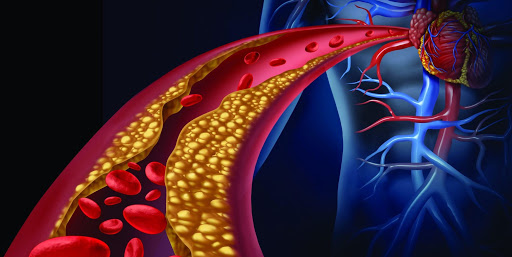 arteriosclerose