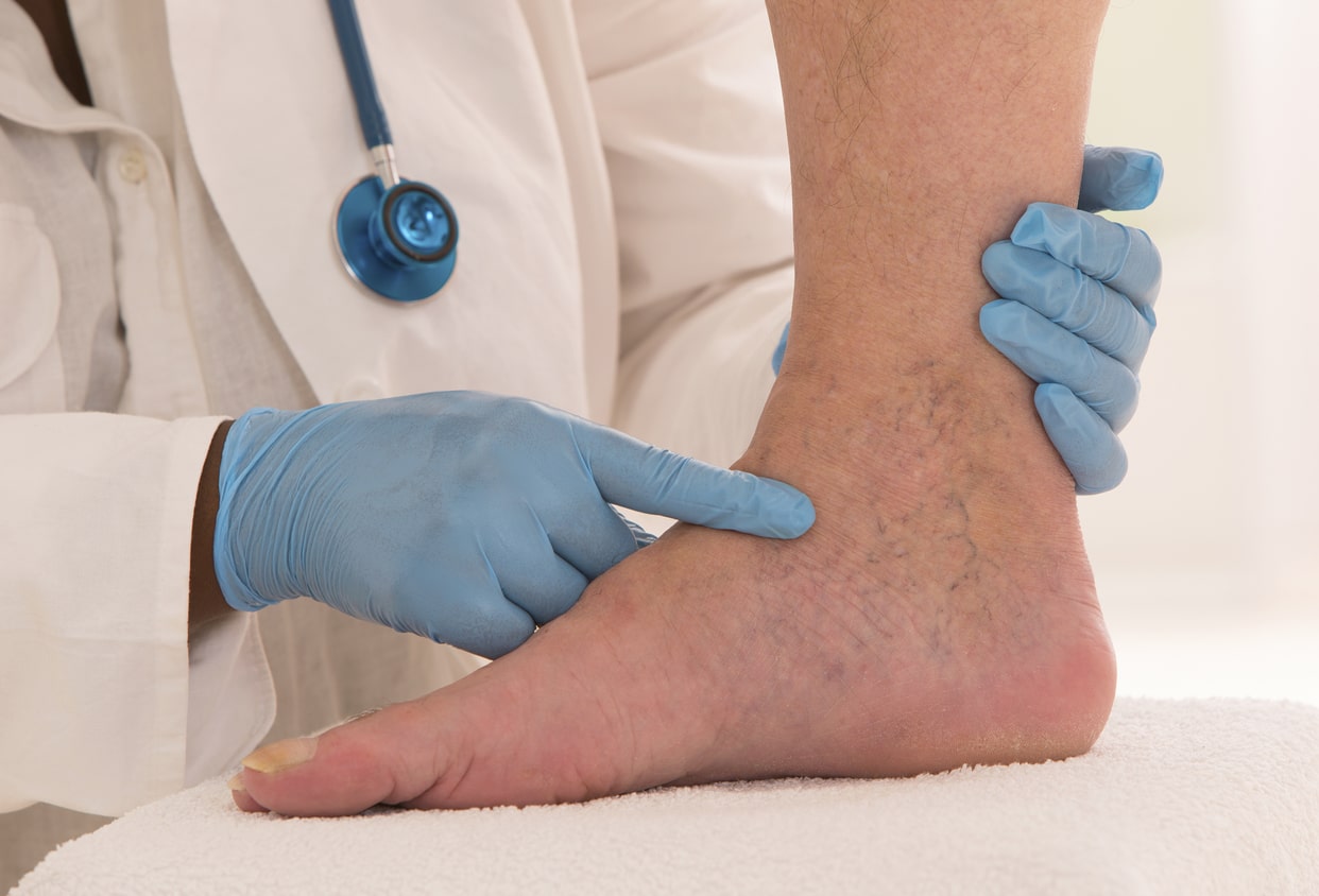 Cirurgia de varizes