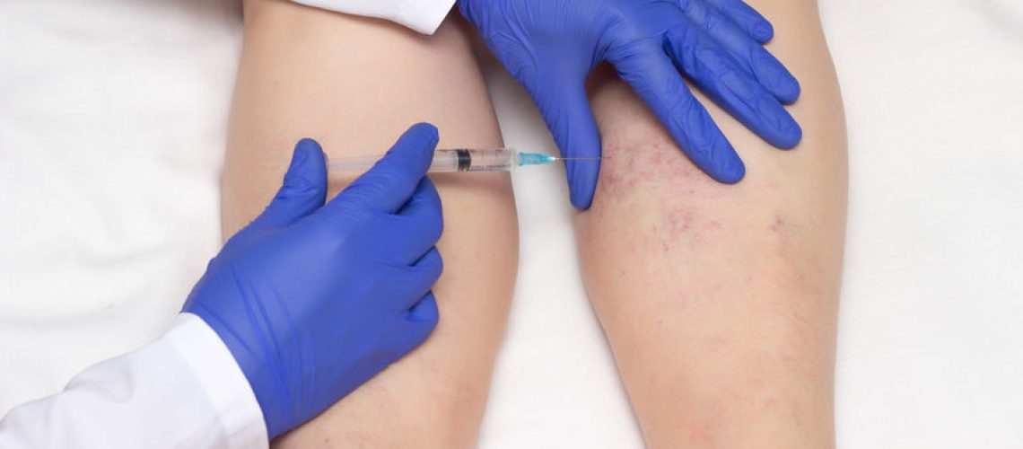 escleroterapia