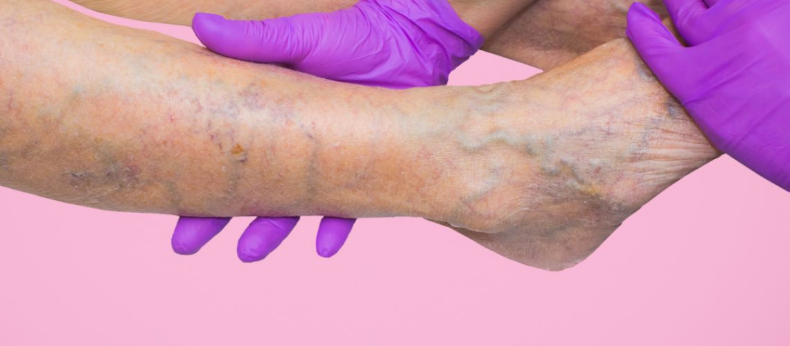 cirurgia de varizes