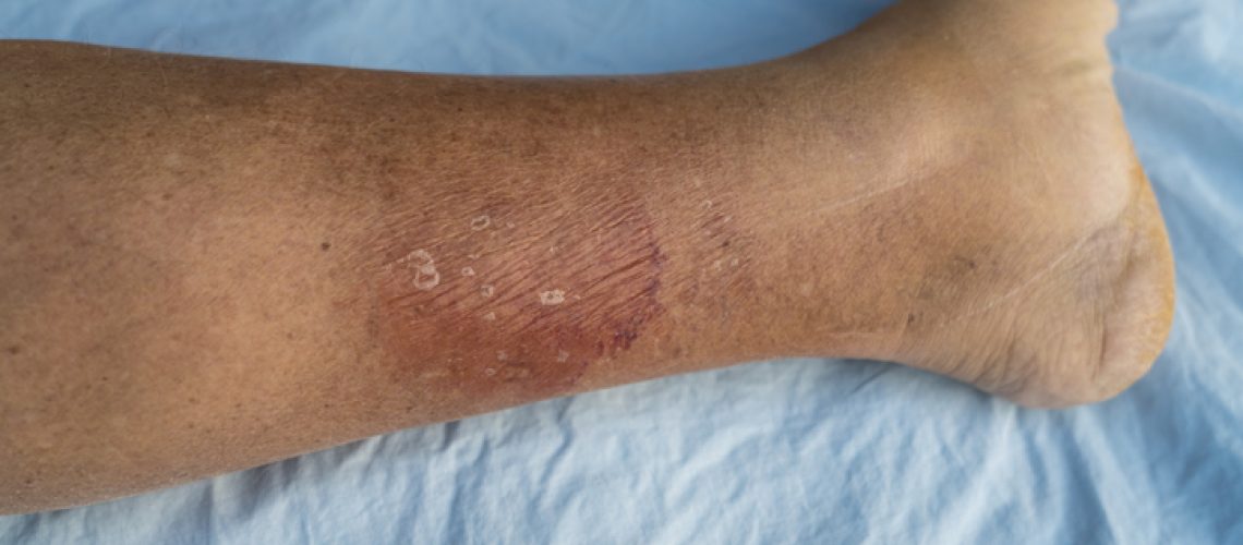 Erysipelas bacterial infection Under the skin leg, on blue bedding.