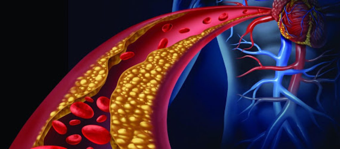 arteriosclerose