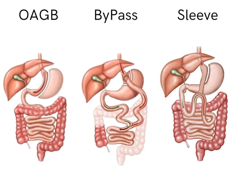Cirurgia bariátrica