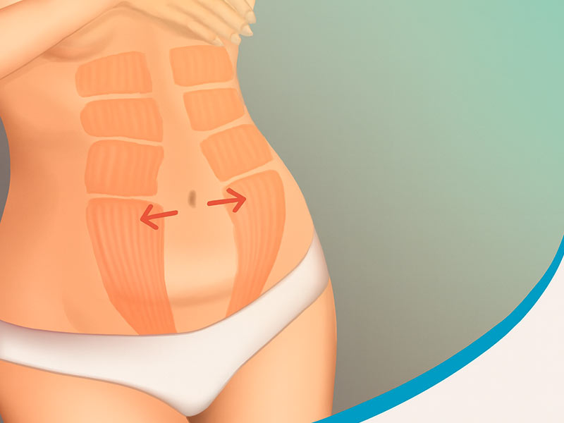 diástase abdominal