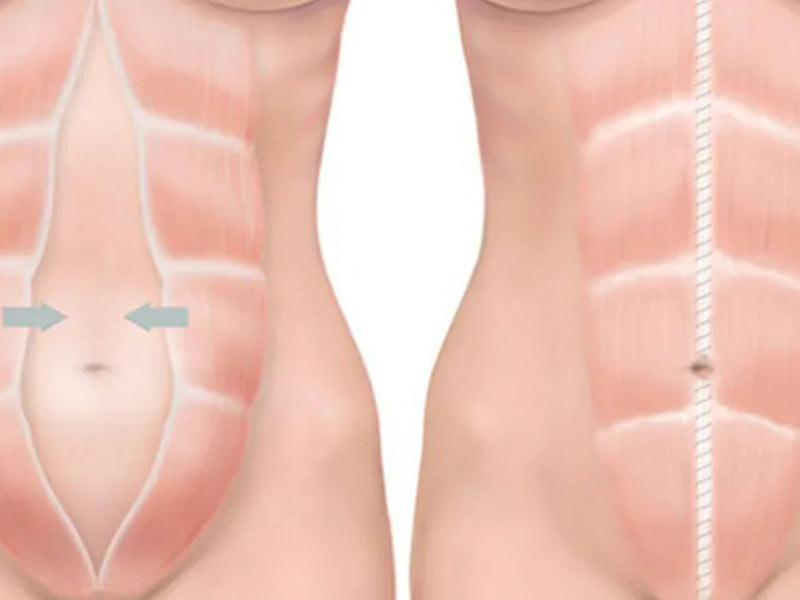 diástase abdominal