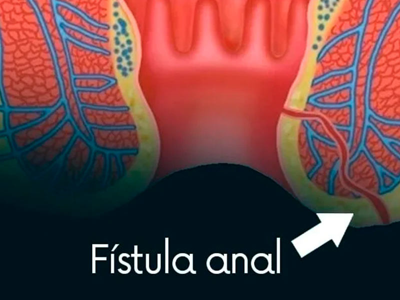 fístula anal
