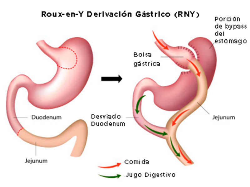 Bypass gástrico