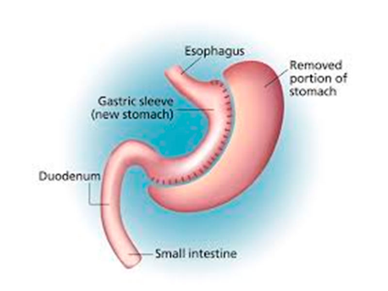 Cirurgia Bariátrica Sleeve