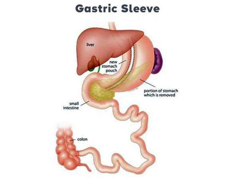 Cirurgia Bariátrica Sleeve