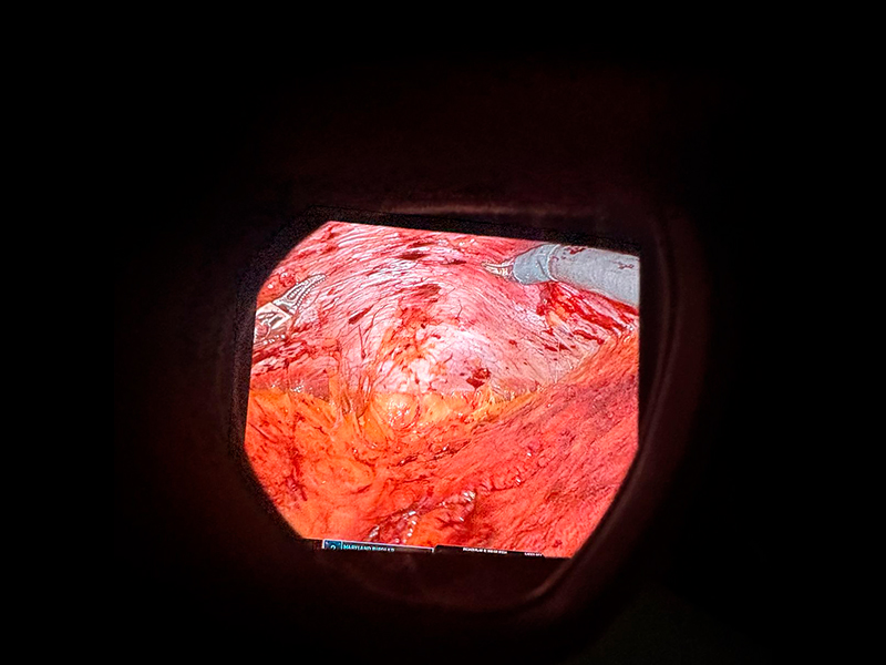 diastase-abdominal