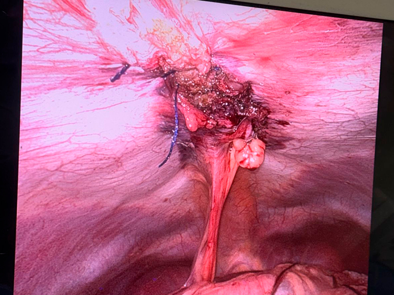 diastase-abdominal
