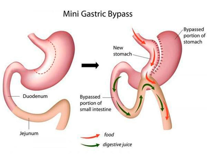 OAGB ou Mini Gastric Bypass