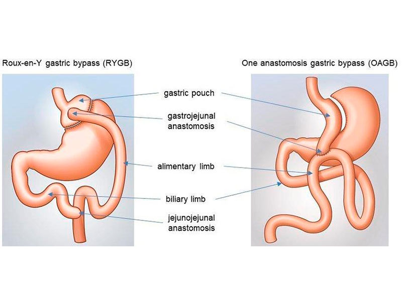 OAGB ou Mini Gastric Bypass