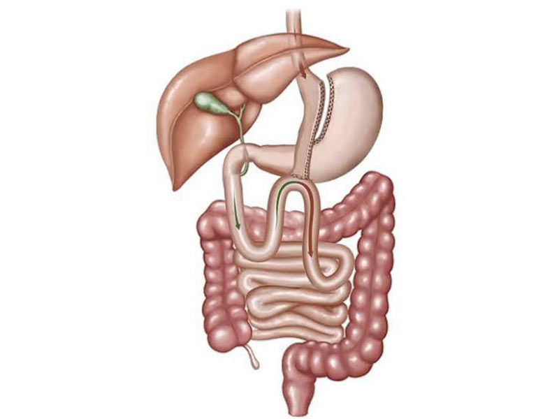 OAGB ou Mini Gastric Bypass
