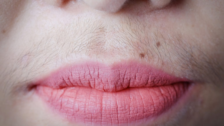 Excesso de pelos