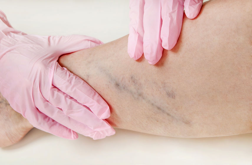 escleroterapia