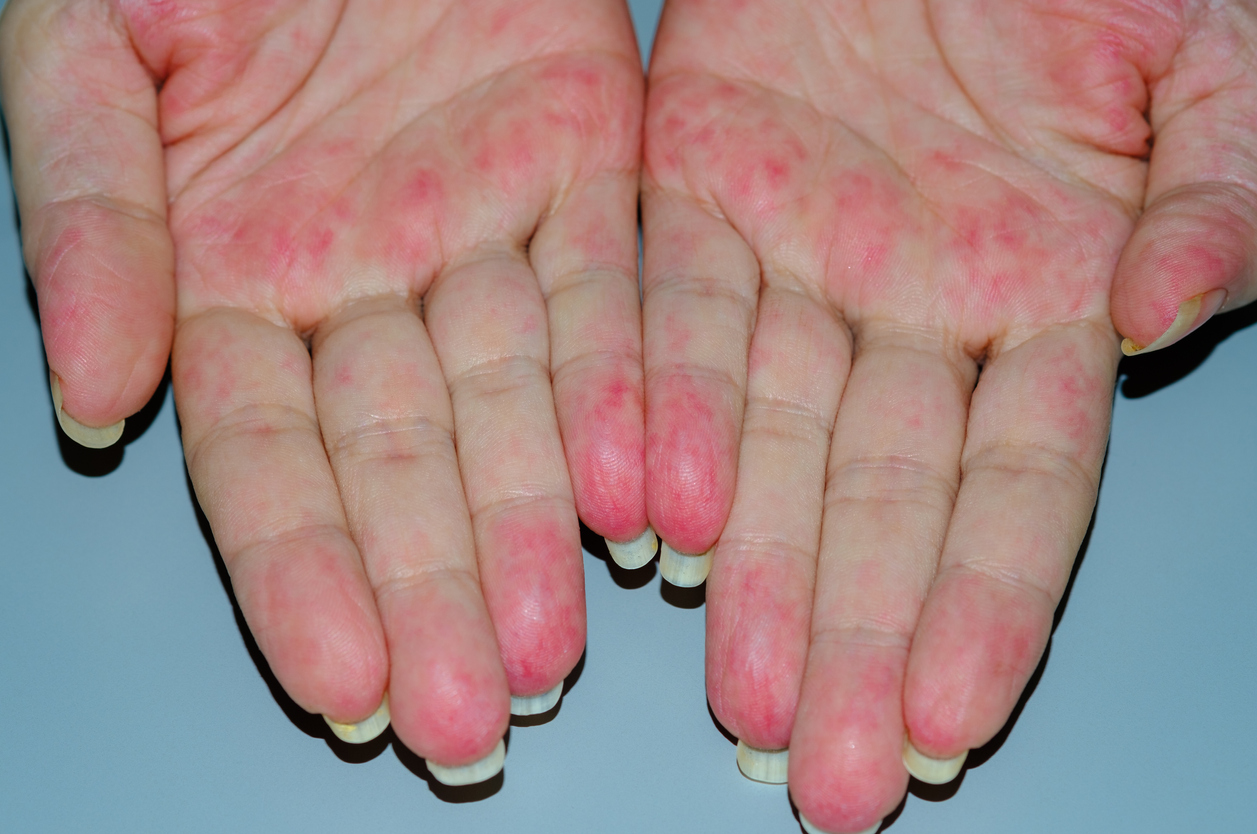 vasculite