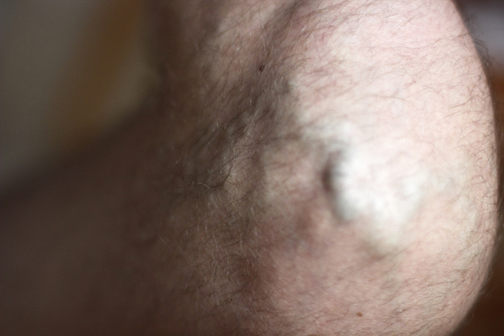 Trombose venosa profunda