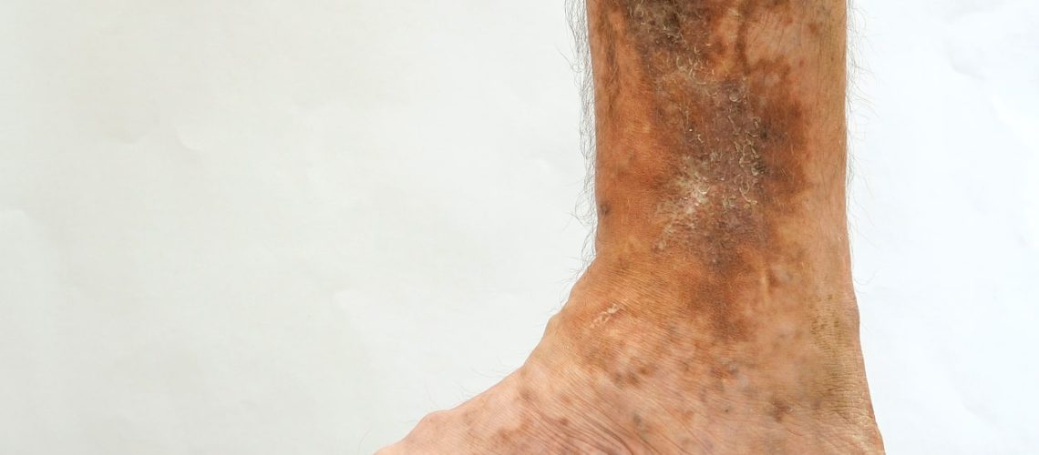 Úlcera venosa