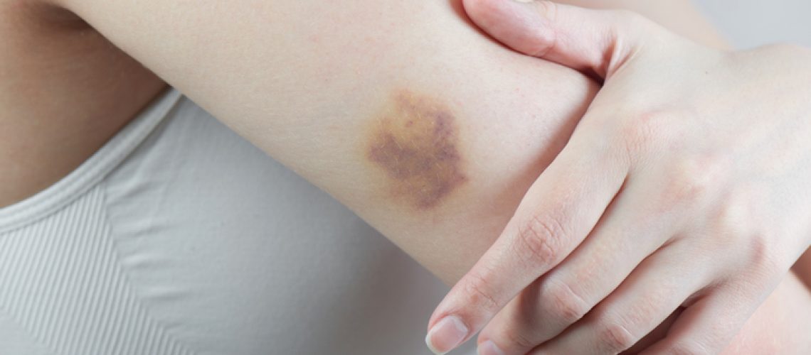 Hematomas