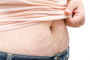 cirurgia de obesidade