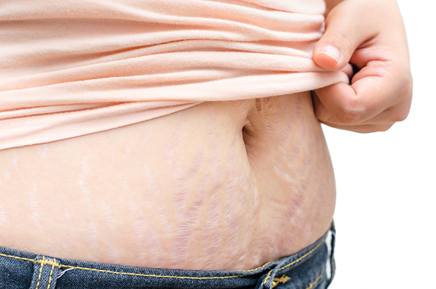 cirurgia de obesidade