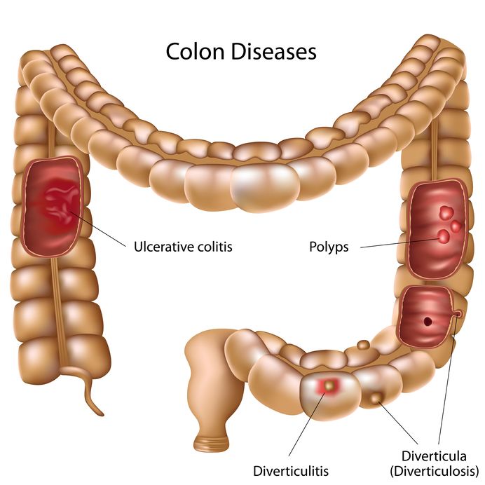 diverticulose