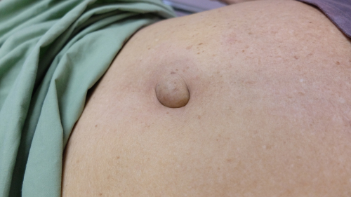 hérnia umbilical