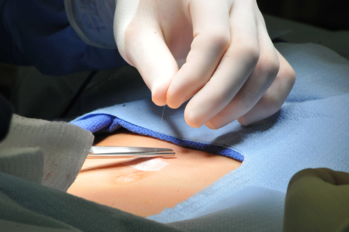 cirurgia de hérnia umbilical