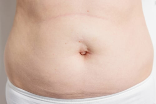 Hérnia umbilical