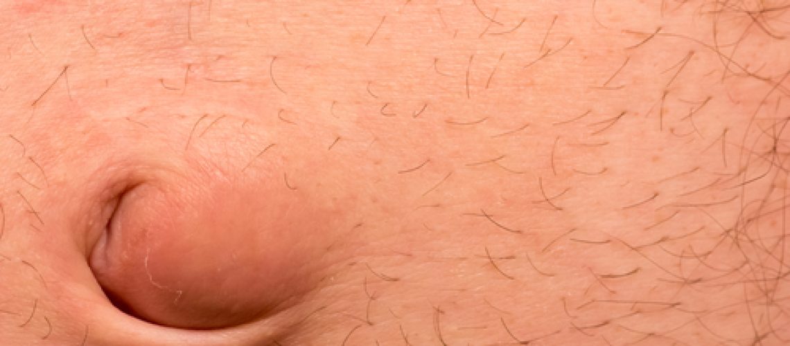 hérnia umbilical