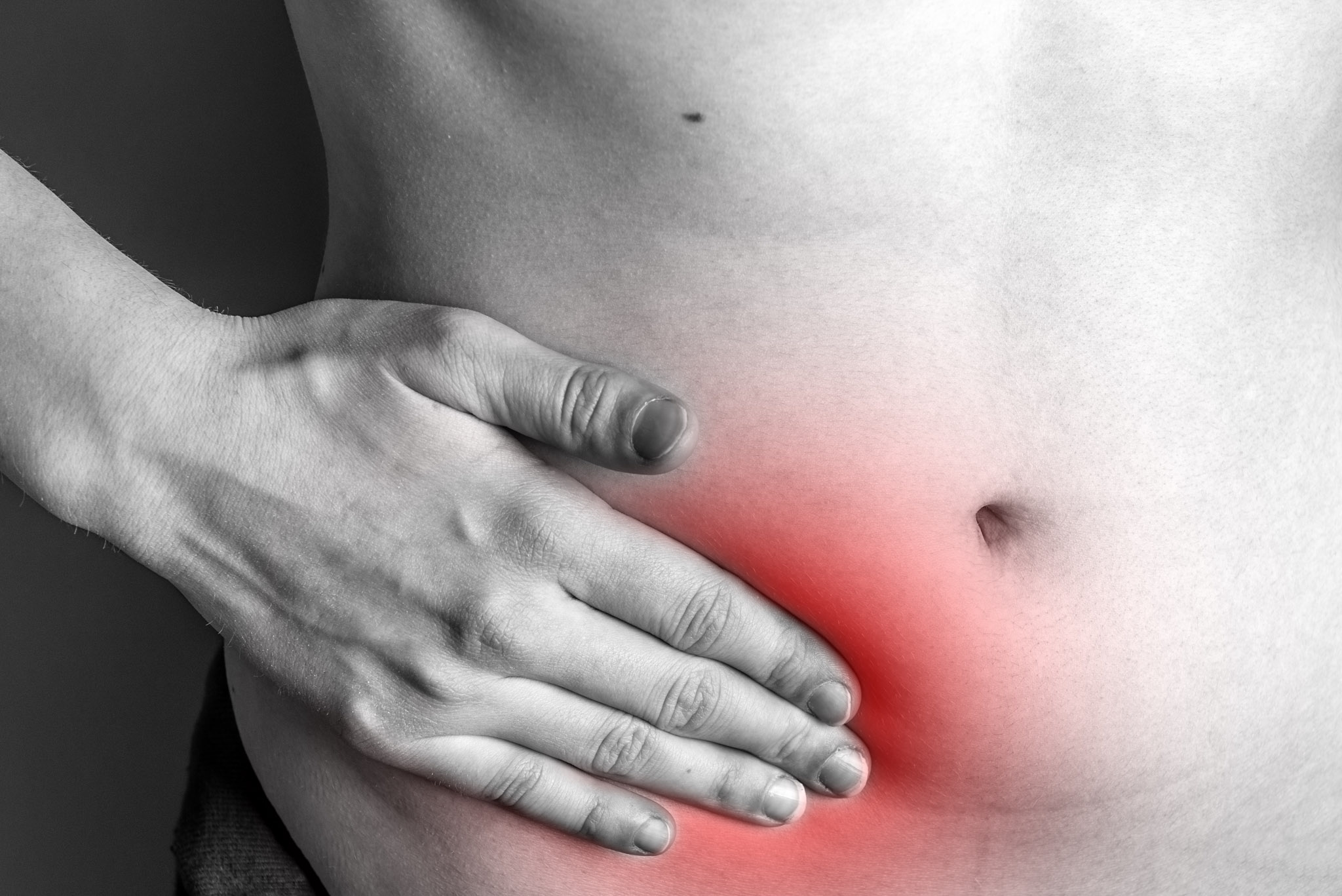 hernia estrangulada