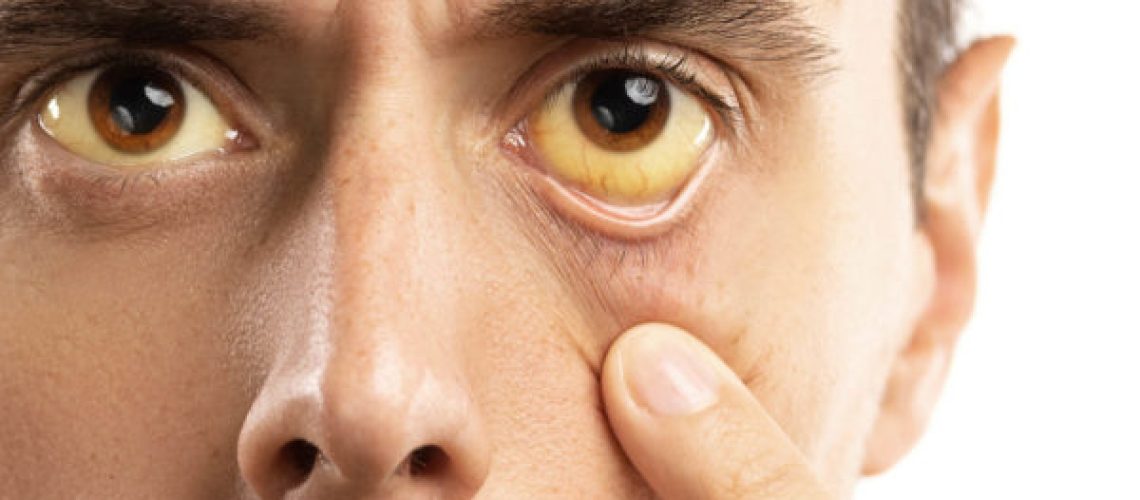 Man checking his health condition. Yellowish eyes is sign of problems with liver, viral infection or other disease.