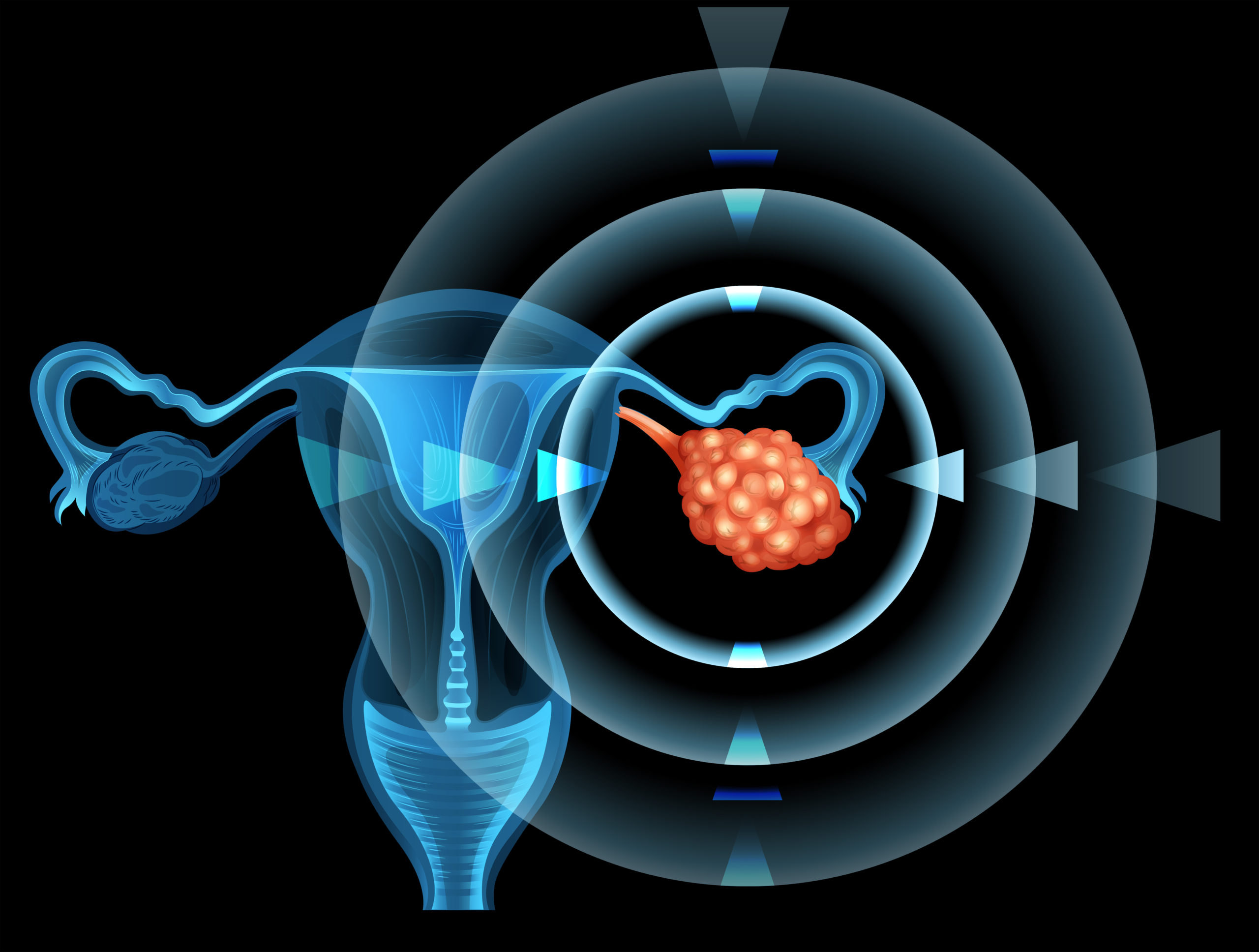 Cirurgia de câncer de ovário
