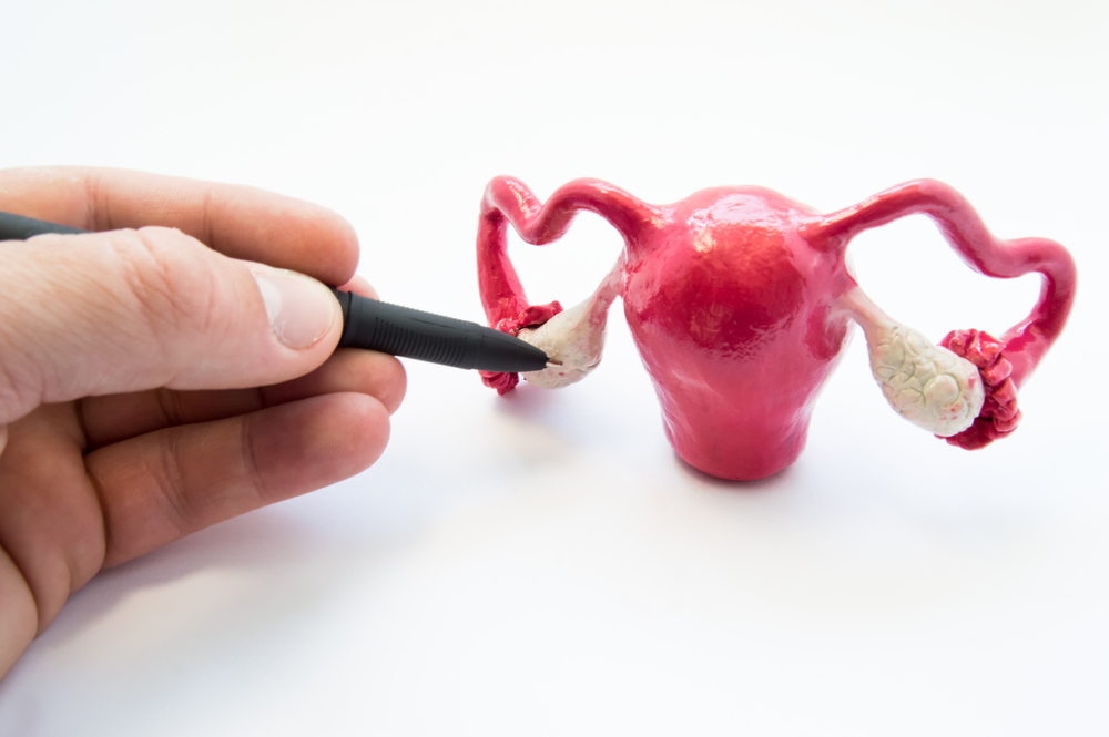 Cirurgia de câncer de ovário