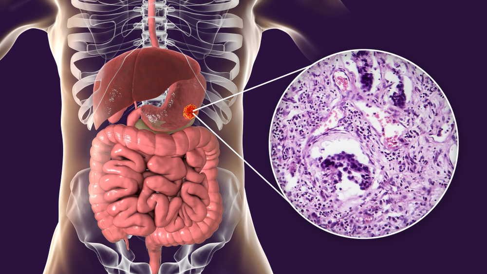 Adenocarcinoma