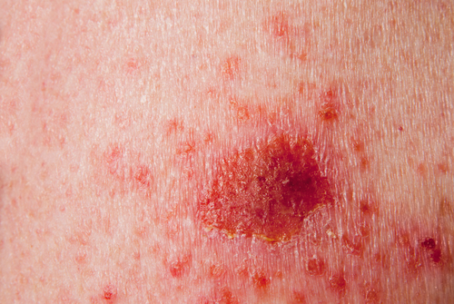Carcinoma basocelular