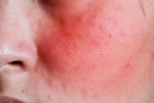 Carcinoma de células escamosas