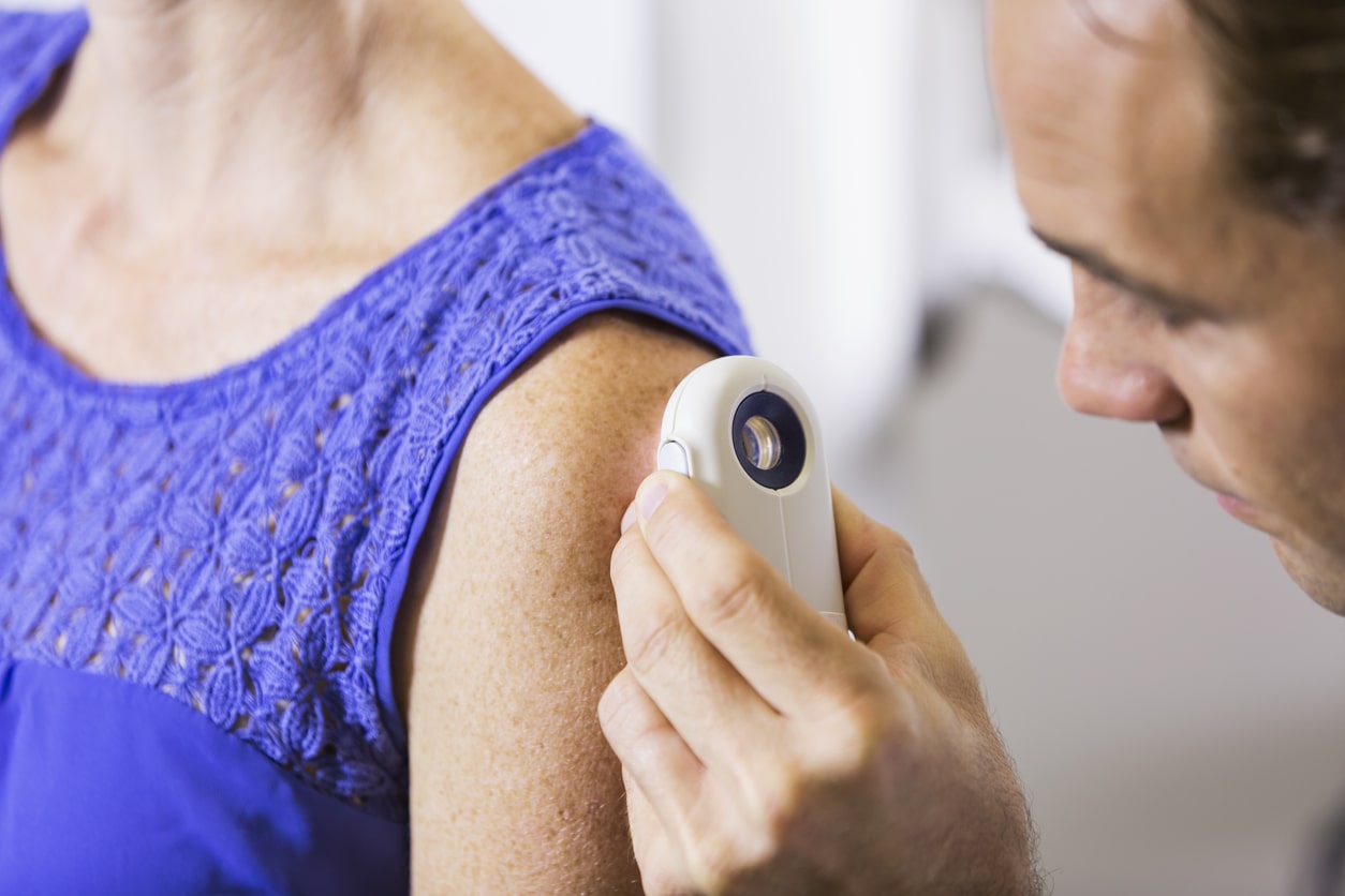 câncer de pele melanoma