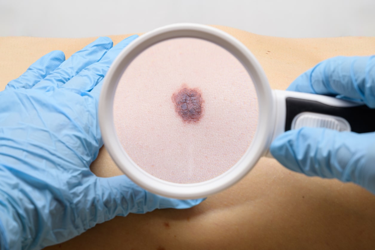 Câncer de pele melanoma