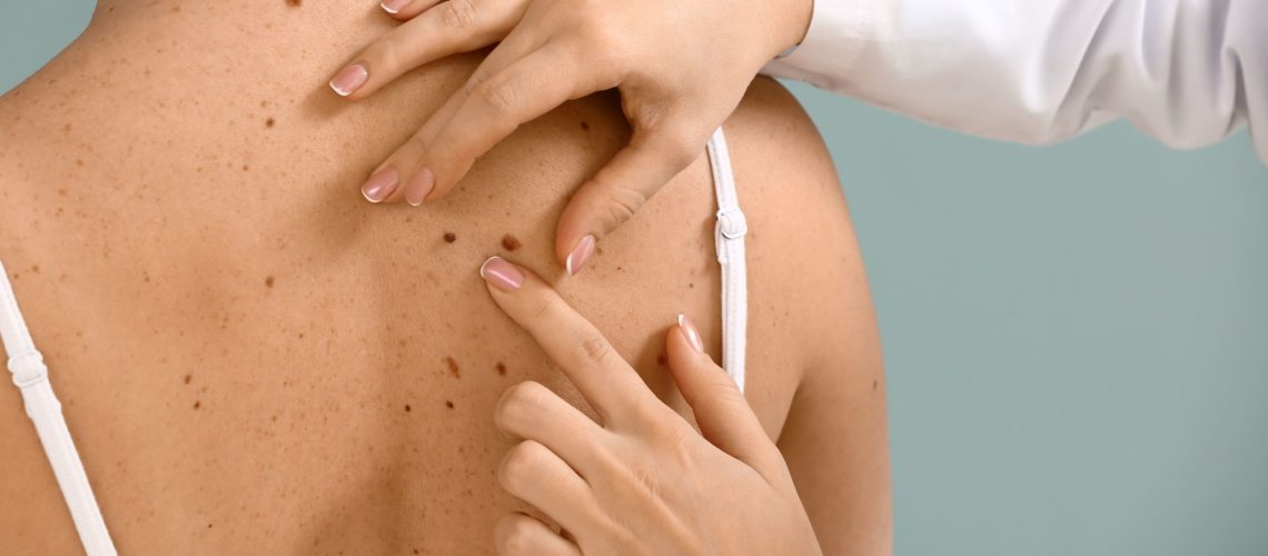 Melanoma