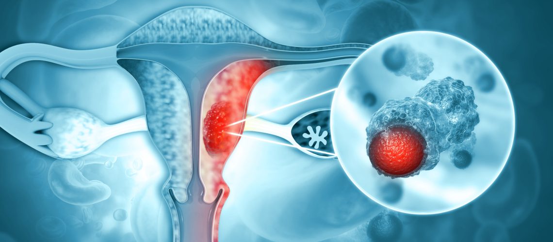 Biópsia Endometrial