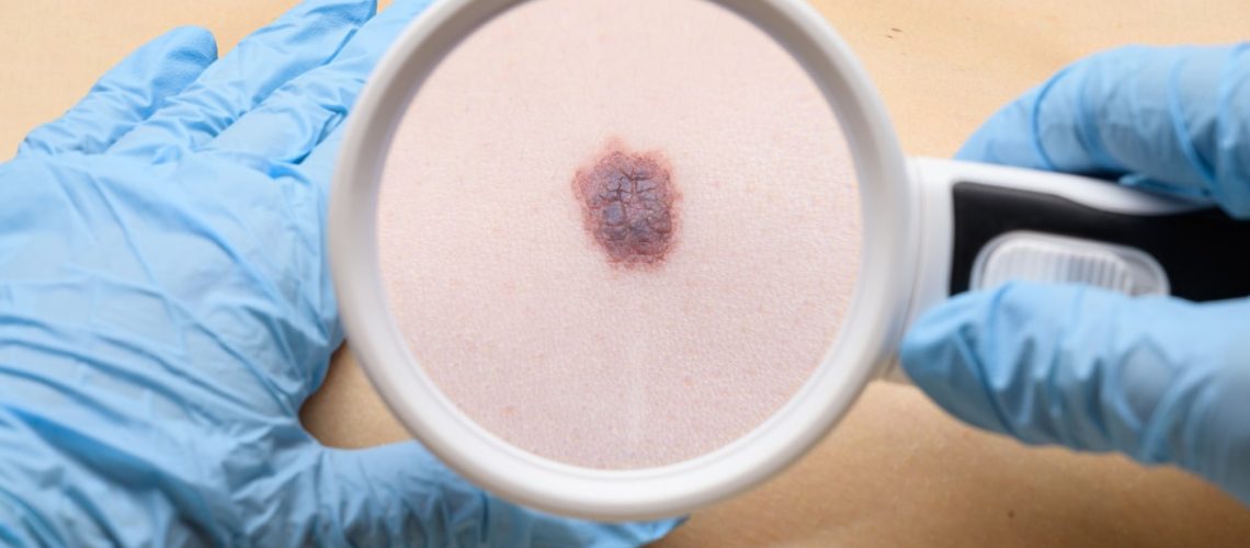 Câncer de pele melanoma