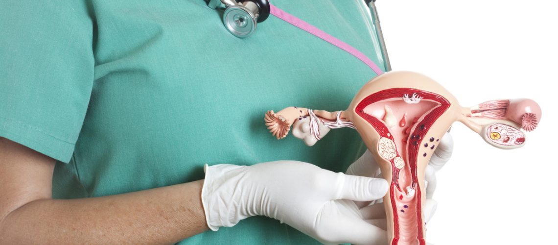 mioma uterino