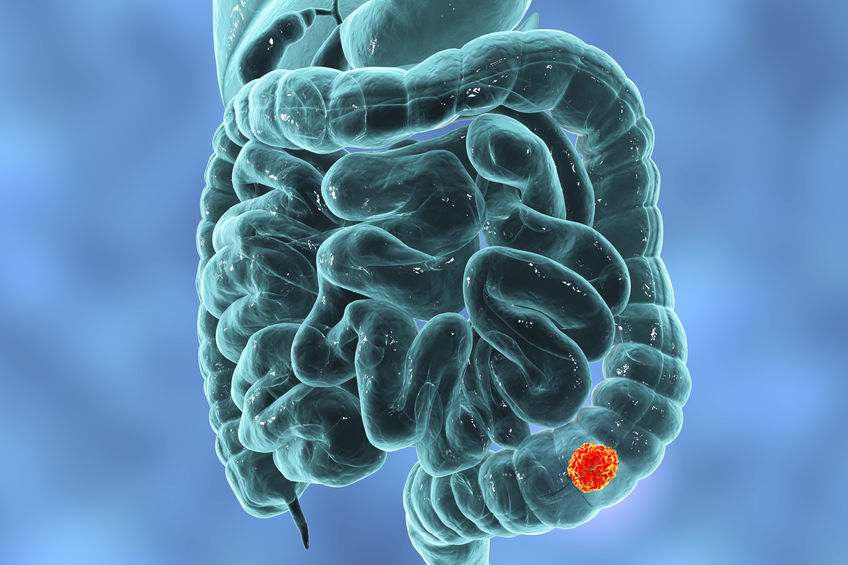 tumor no intestino